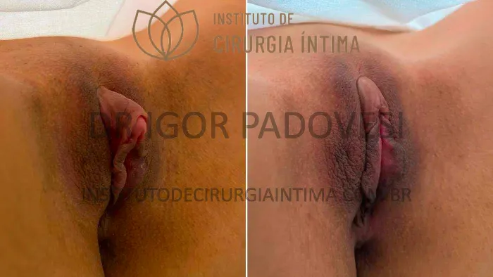 clitoroplastias_exemplos_dr_igor_padovesi_set26_Página_02 1_1x