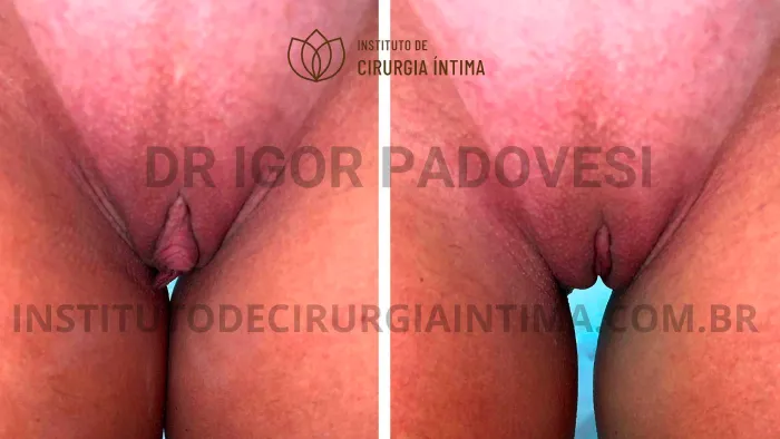clitoroplastias_exemplos_dr_igor_padovesi_set26_Página_03 1_1x