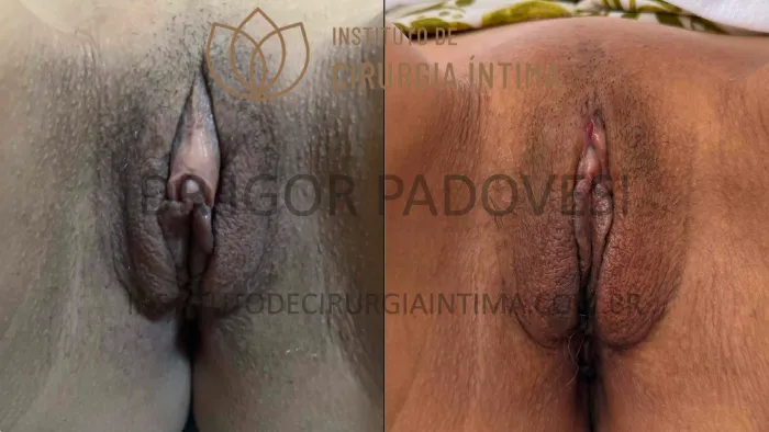 clitoroplastias_exemplos_dr_igor_padovesi_set26_Página_09 1_1x