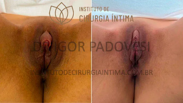 clitoroplastias_exemplos_dr_igor_padovesi_set26_Página_13 1_1x