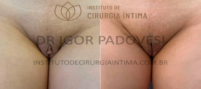 clitoroplastias_exemplos_dr_igor_padovesi_set26_Página_14 1_1x