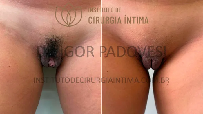 clitoroplastias_exemplos_dr_igor_padovesi_set26_Página_15 1_1x