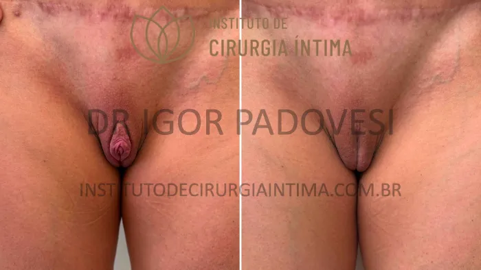 clitoroplastias_exemplos_dr_igor_padovesi_set26_Página_18 1_1x