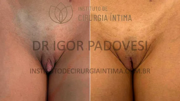 clitoroplastias_exemplos_dr_igor_padovesi_set26_Página_21 1_1x