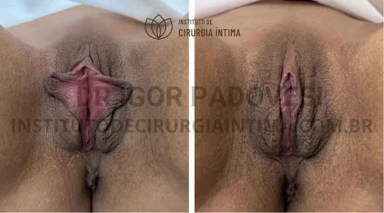 exemplos_ninfoplastias_capuz_clitoriano_set26_part1_Página_04_Imagem_0001 1_1x