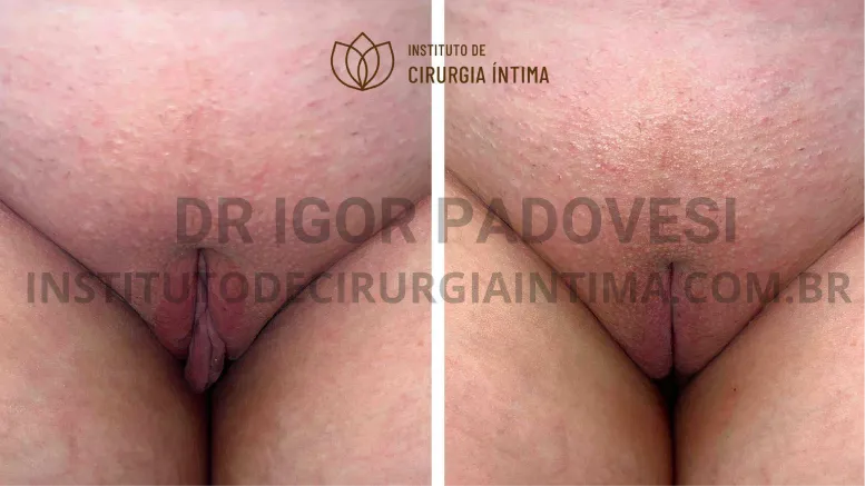 exemplos_ninfoplastias_capuz_clitoriano_set26_part1_Página_17_Imagem_0001 1_1x