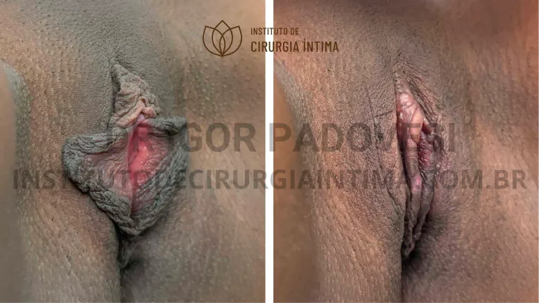 exemplos_ninfoplastias_capuz_clitoriano_set26_part1_Página_21_Imagem_0001 1_1x