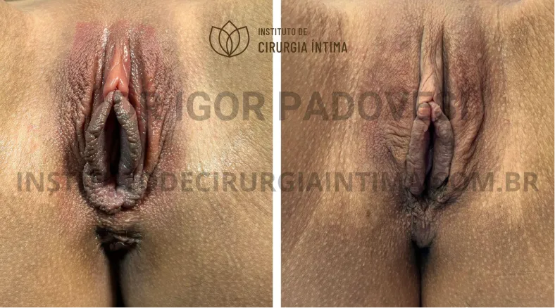 exemplos_ninfoplastias_capuz_clitoriano_set26_part1_Página_22_Imagem_0001 1_1x