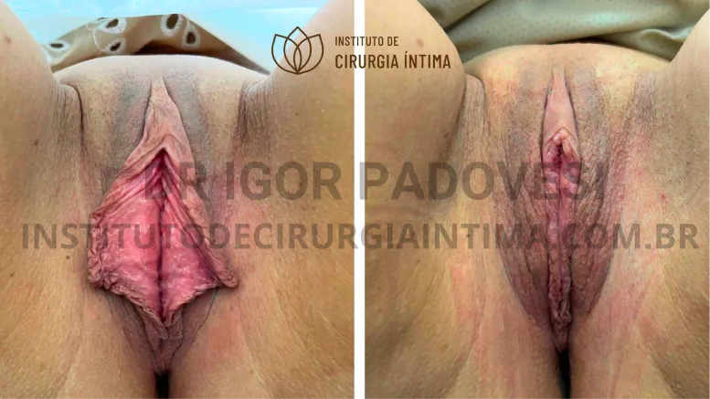 exemplos_ninfoplastias_capuz_clitoriano_set26_part1_Página_25_Imagem_0001 1_1x