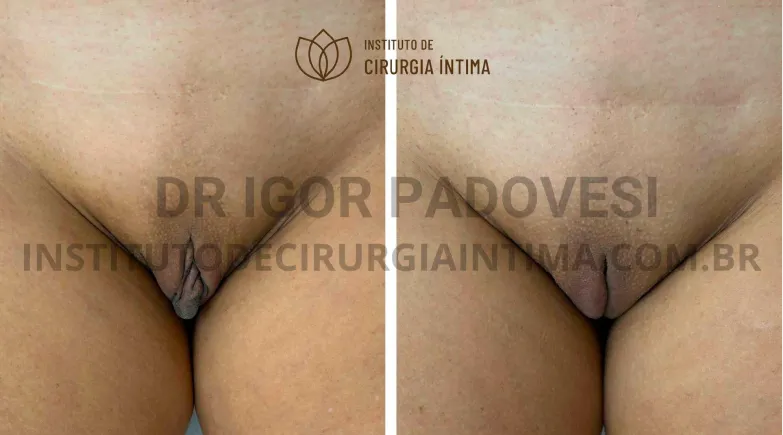 exemplos_ninfoplastias_capuz_clitoriano_set26_part1_Página_26_Imagem_0001 1_1x