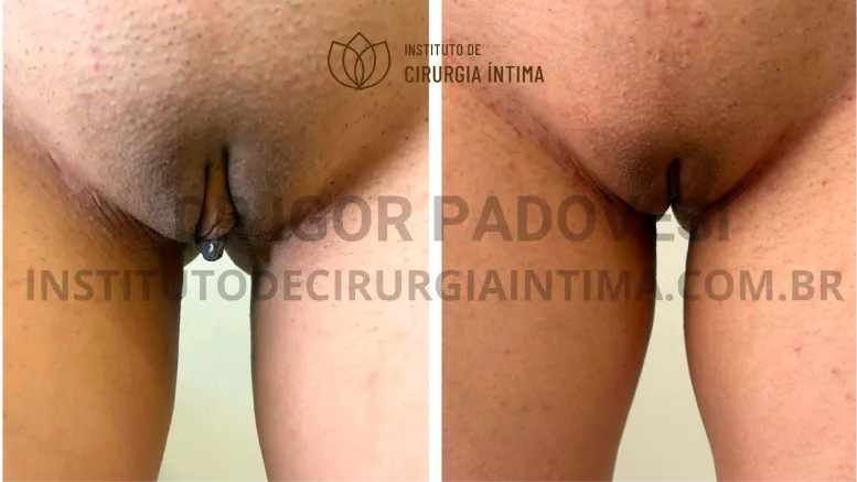 exemplos_ninfoplastias_capuz_clitoriano_set26_part1_Página_30_Imagem_0001 1_1x