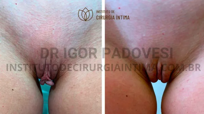 exemplos_ninfoplastias_capuz_clitoriano_set26_part2_Página_02_Imagem_0001 1_1x