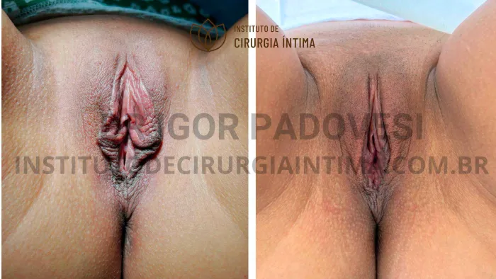 exemplos_ninfoplastias_capuz_clitoriano_set26_part2_Página_04_Imagem_0001 1_1x