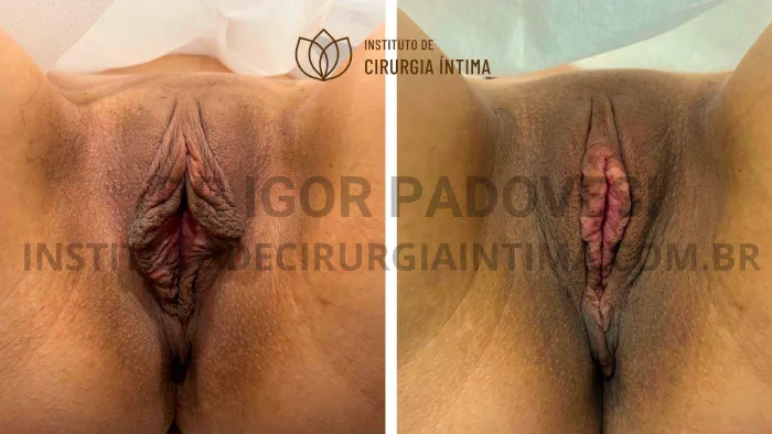 exemplos_ninfoplastias_capuz_clitoriano_set26_part2_Página_06_Imagem_0001 1_1x