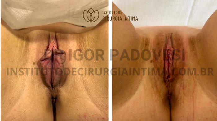 exemplos_ninfoplastias_capuz_clitoriano_set26_part2_Página_10_Imagem_0001 1_1x