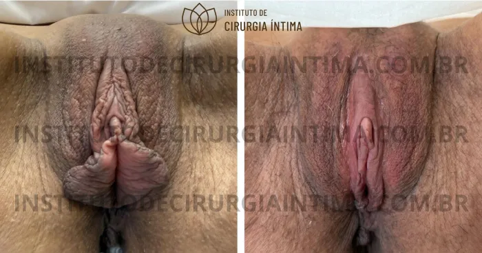exemplos_ninfoplastias_capuz_clitoriano_set26_part2_Página_13_Imagem_0001 1_1x