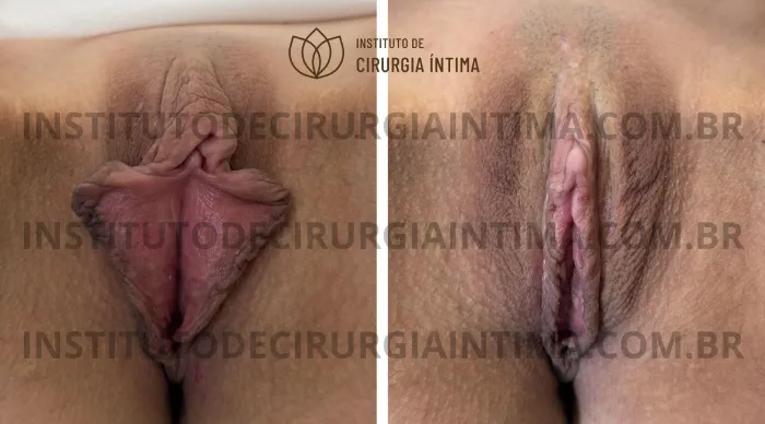exemplos_ninfoplastias_capuz_clitoriano_set26_part2_Página_14_Imagem_0001 1_1x