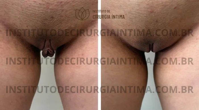 exemplos_ninfoplastias_capuz_clitoriano_set26_part2_Página_15_Imagem_0001 1_1x