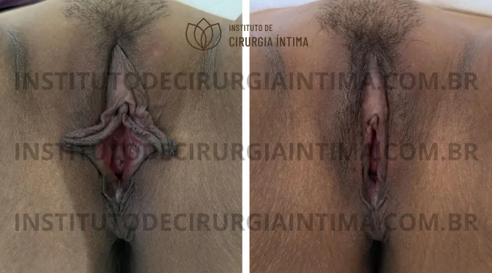 exemplos_ninfoplastias_capuz_clitoriano_set26_part2_Página_26_Imagem_0001 1_1x