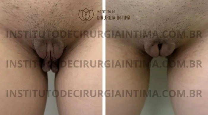 exemplos_ninfoplastias_capuz_clitoriano_set26_part2_Página_28_Imagem_0001 1_1x