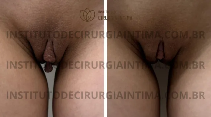 exemplos_ninfoplastias_capuz_clitoriano_set26_part2_Página_29_Imagem_0001 1_1x